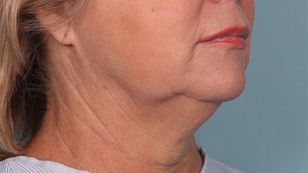 Before-Neck Lipo