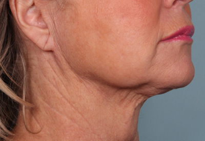 Neck Lipo Toronto Before After Rice Cosmetic Surgery
