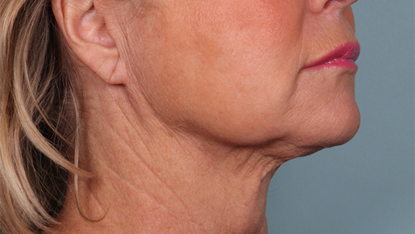 After-Neck Lipo