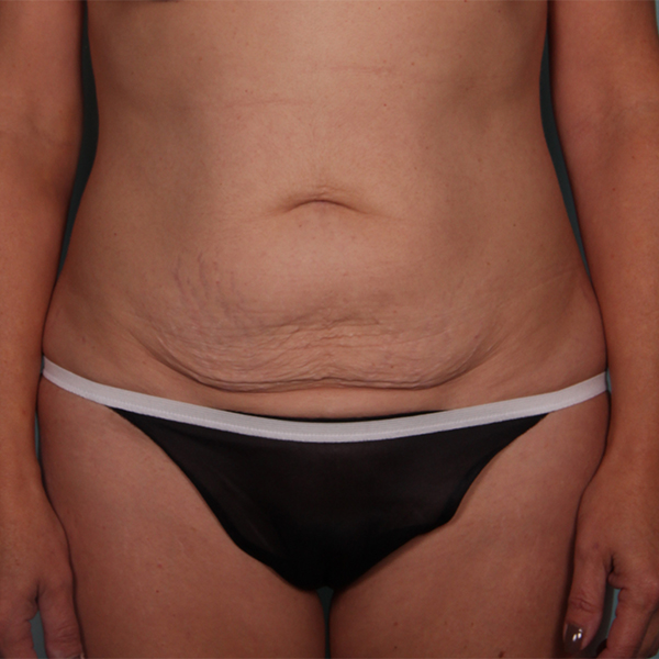 Before-Tummy Tuck