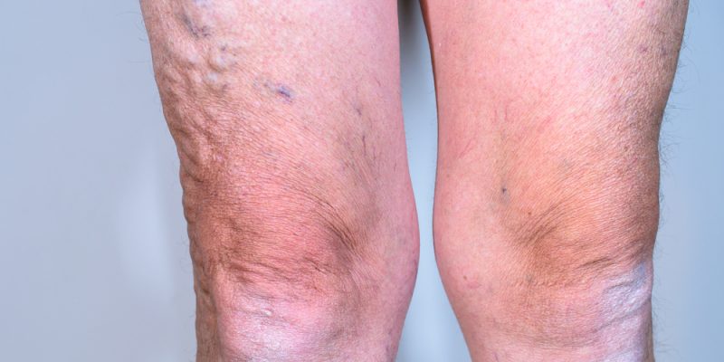 Varicose Veins - Rice Cosmetic Surgery - Toronto, Ontario