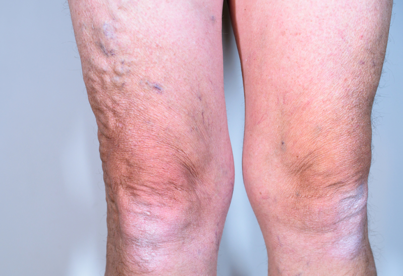 Varicose Veins - Rice Cosmetic Surgery - Toronto, Ontario