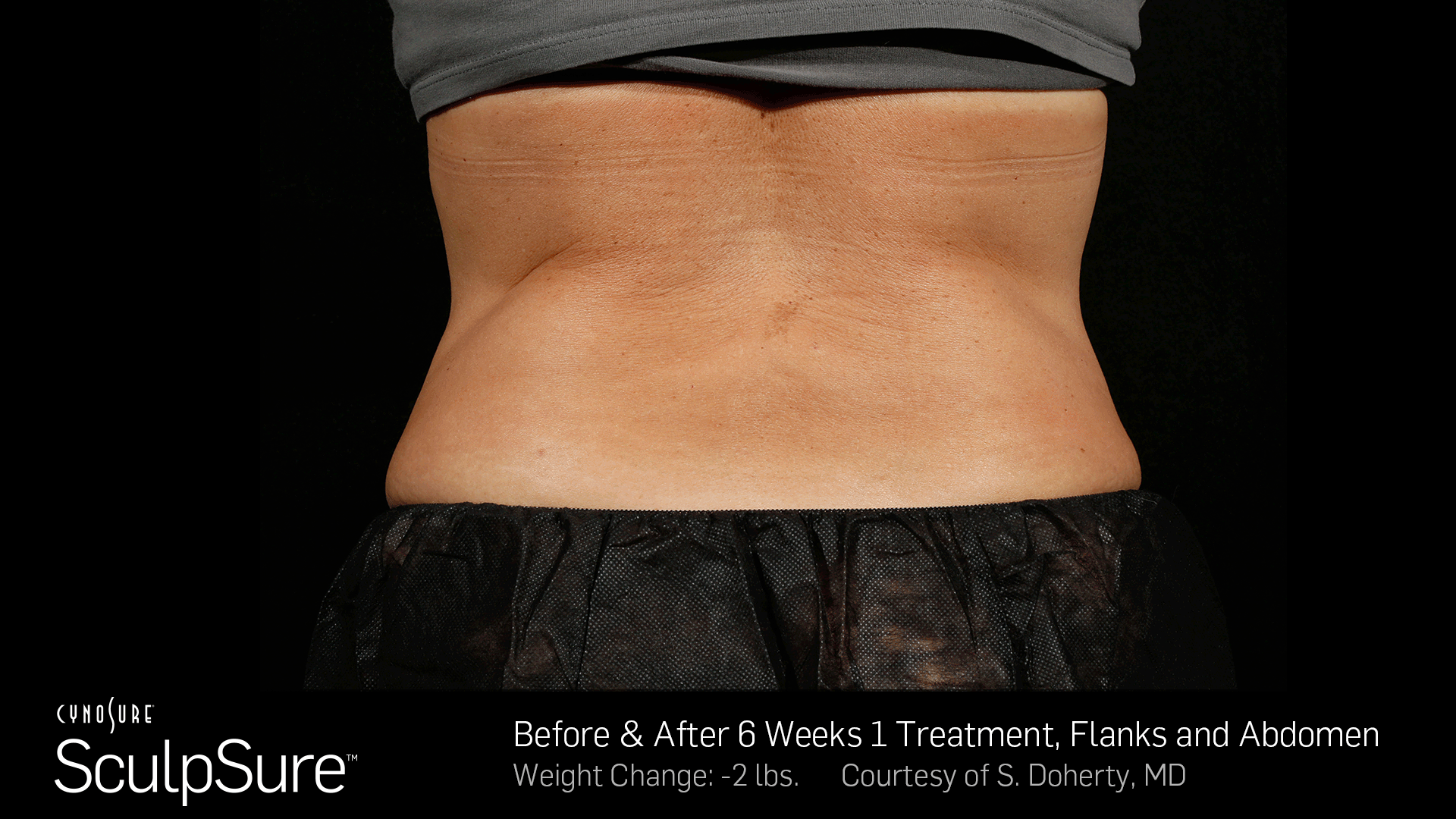 Sculpsure Before and After Toronto