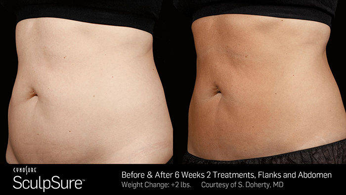 Sculpsure Before and After Photos - After Two Treatments - Toronto