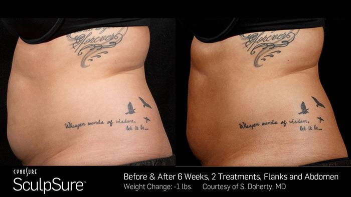 Sculpsure Toronto Before and After Photos Two Treatments