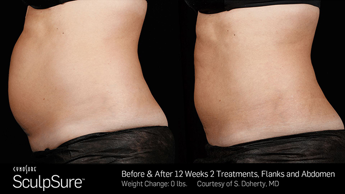 Sculpsure Toronto Before and After Photos Two Treatments