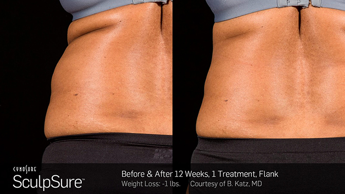 Sculpsure Toronto Before and After One Photos One Treatment