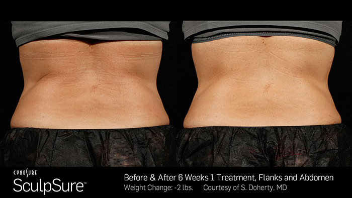 Sculpsure Toronto Before and After One Photos One Treatment