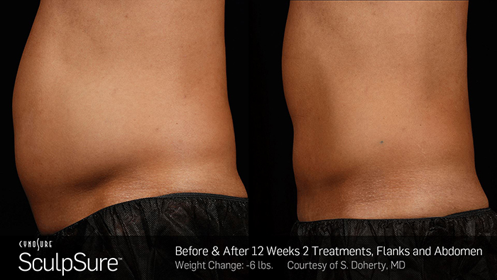 Sculpsure Toronto Before and After Photos Two Treatments
