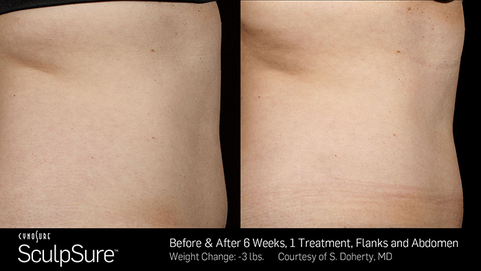 Sculpsure Toronto Before and After One Photos One Treatment